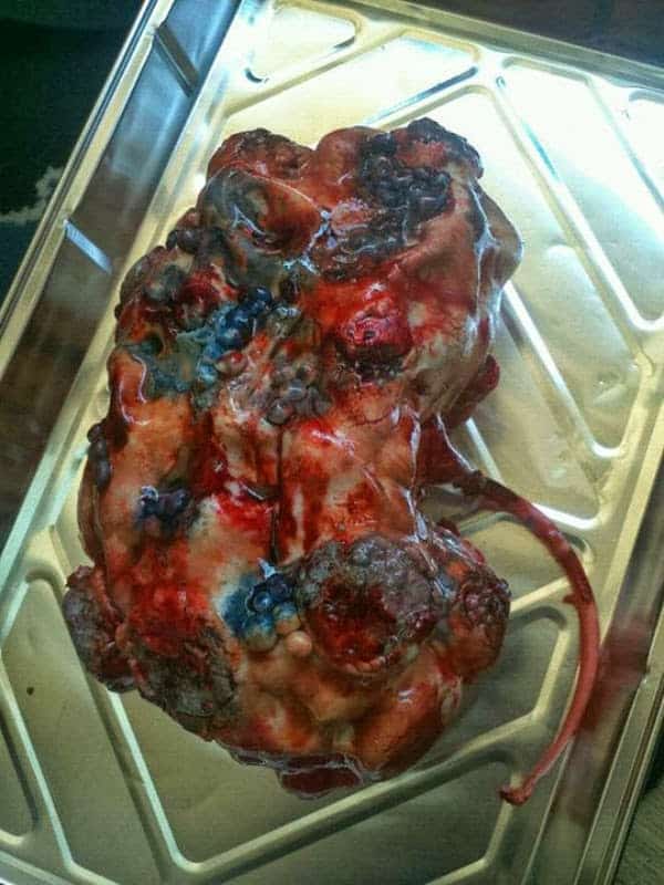 Weird_Creepy_Spooky_and_Scary_Halloween_Cakes_Polycistic_Kidney_Disease_cake